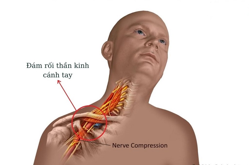 Bệnh đám rối thần kinh cánh tay di truyền